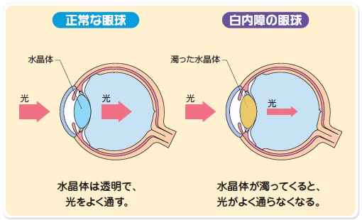 正常な眼球　水晶体は透明で、光を良く通す。　白内障の眼球　水晶体が濁ってくると、光がよく通らなくなる。