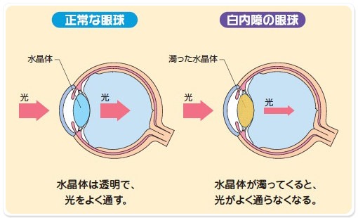 正常な眼球 水晶体は透明で、光を良く通す。 白内障の眼球 水晶体が濁ってくると、光がよく通らなくなる。