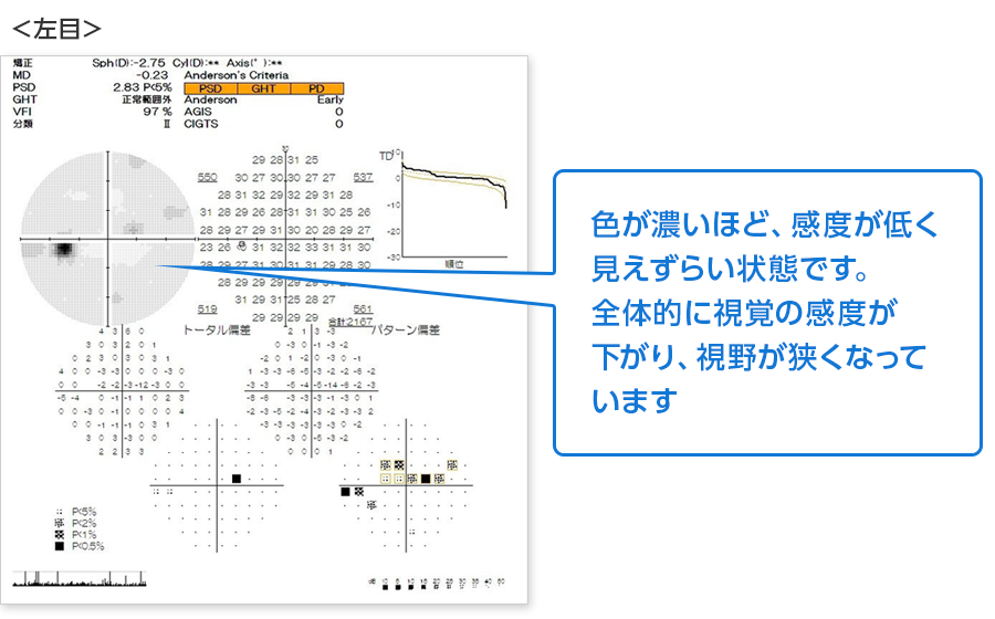 視野検査