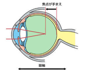 近視