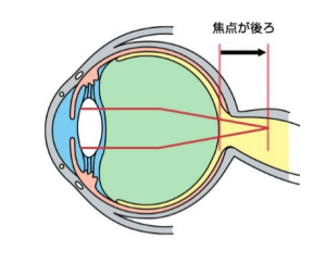 遠視